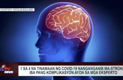 1 sa 4 na tinamaan ng COVID-19 nanganganib ma-stroke, iba pang komplikasyon ayon sa mga eksperto